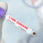 Comment détecter la maladie de Lyme ?